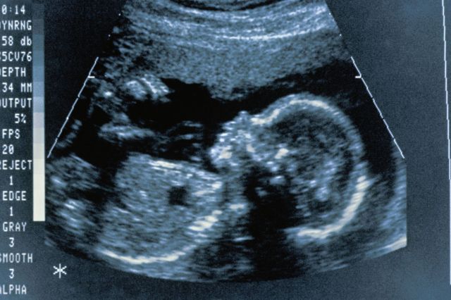 ultrasound-scan-of-twenty-week-old-foetus